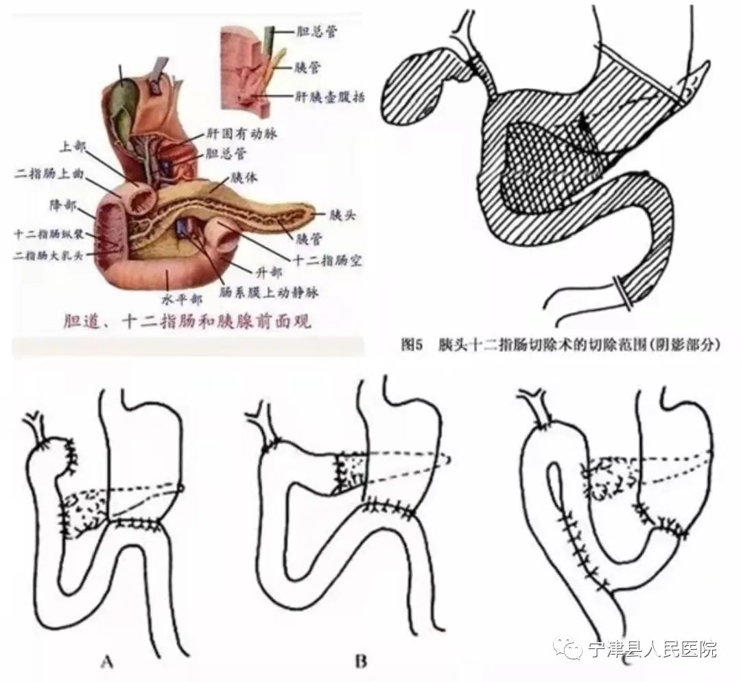 图14-17 乙状结肠的位置变异-外科学-医学