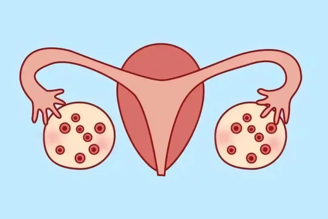 多囊卵巢综合症能自愈图片